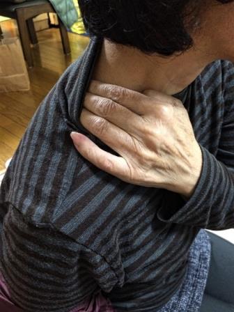 首のヘルニアで肩がズキズキ痛む　札幌４０代女性